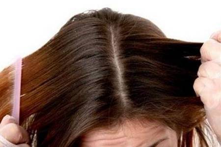 除头皮屑小妙招